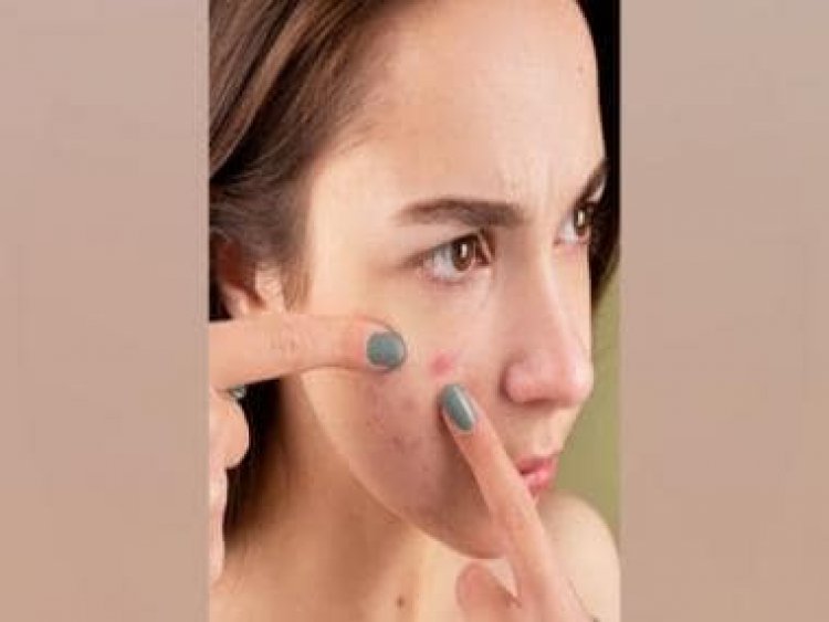 Treatment for acne scars: The types and their relevance explained