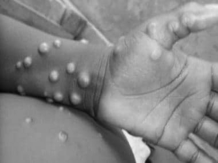 Monkeypox cases concentrated among men who have sex with men: WHO