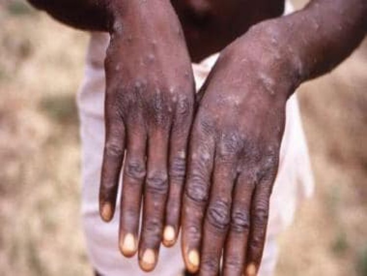How the current monkeypox outbreak can become endemic