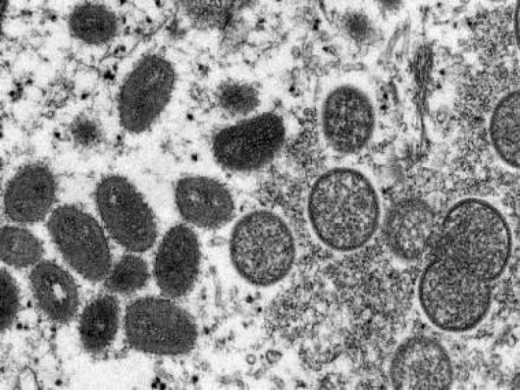 In a first, man tests positive for COVID-19, HIV, monkeypox at the same time