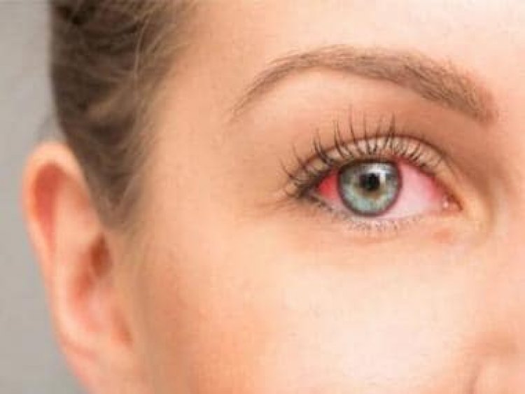 Irritated with itching sensation in your eyes? Check out these home remedies