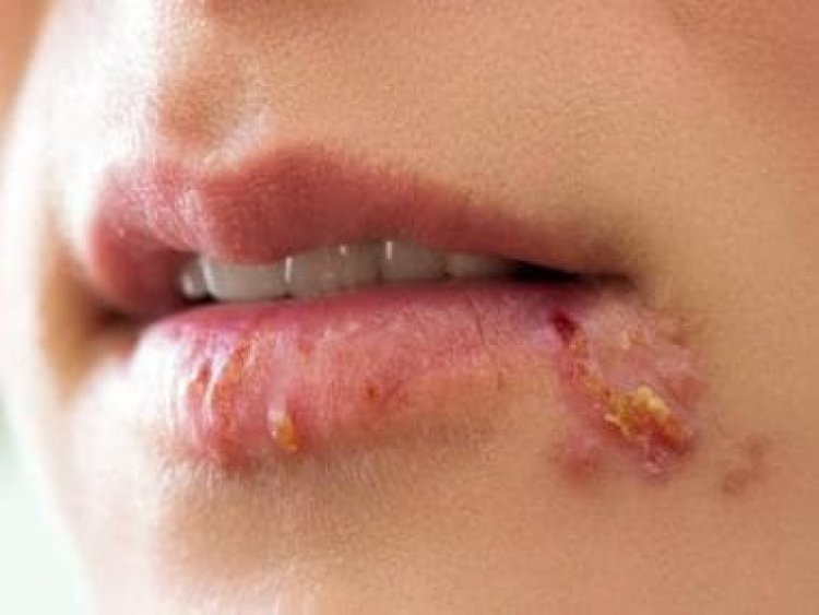 Herpes Infections: Types, causes, risks and treatment