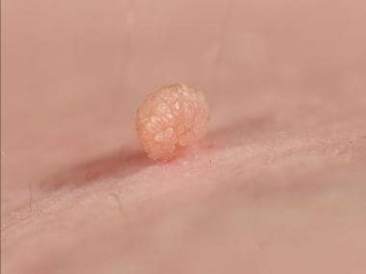 Five remedies to remove skin tags at home