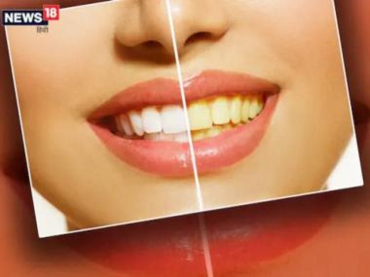 From baking soda to apple cider vinegar, 5 home remedies to whiten teeth