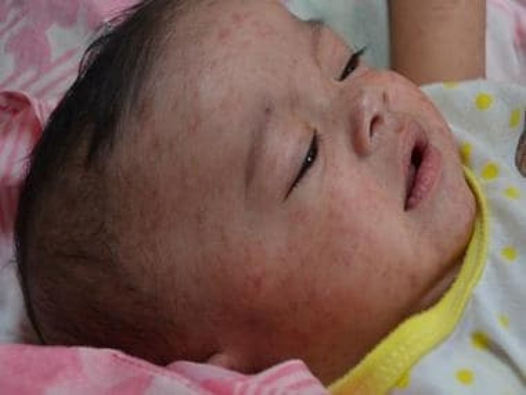 Should measles vaccine be given at six months instead of nine for infants?