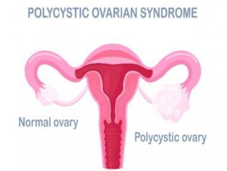 Lean PCOS may remain undiagnosed due to normal BMI levels