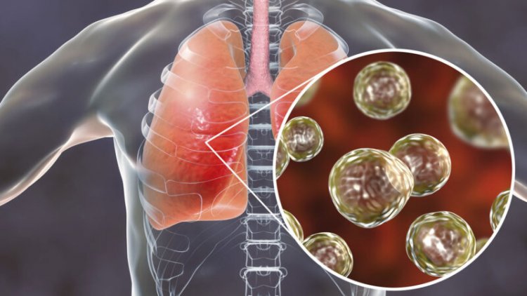 4 key things to know about lung infections caused by fungi