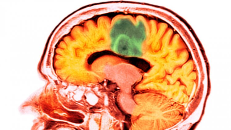 Ultrasound allows a chemotherapy drug to enter the human brain