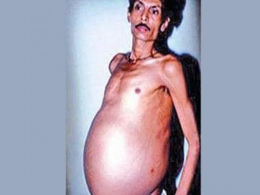 Maharashtra man carried twin inside body for 36 years thinking he was fat all along