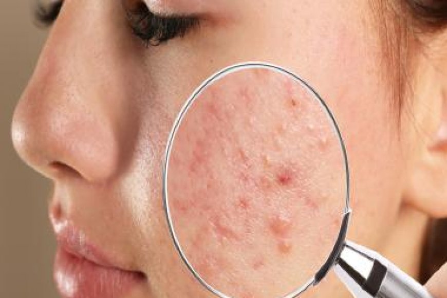 Identifying the culprits of Acne and Navigating Effective Treatments 