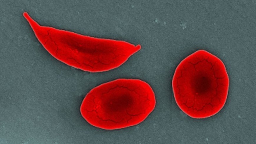 The first CRISPR therapy approved in the U.S. will treat sickle cell disease