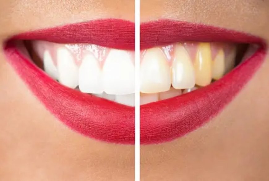 Oral Health: 5 Foods That Can Naturally Whiten Teeth And Brighten up Your Smile