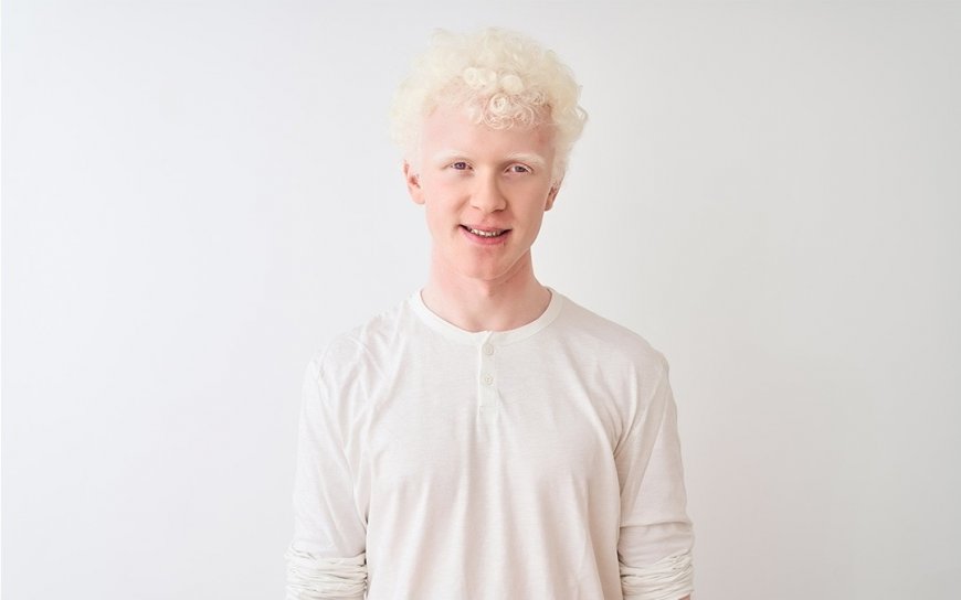 International Albinism Awareness Day 2024: Signs, Causes And Treatment of The Rare Genetic Condition