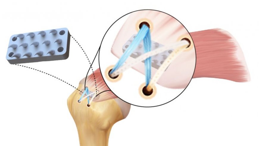 This python-inspired device could make rotator cuff surgeries more effective