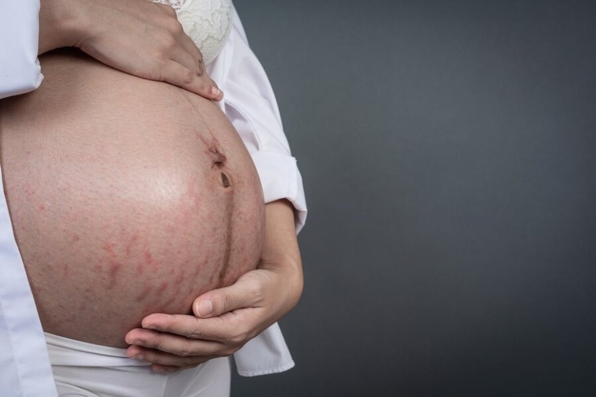 Stretch Marks to Acne, 5 Skin Problems Women Face During Pregnancy