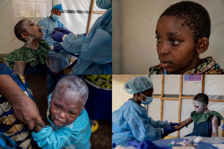 EXPLAINER: With WHO Declaring Mpox Global Health Emergency, Will It Trigger Another COVID Like Pandemic?