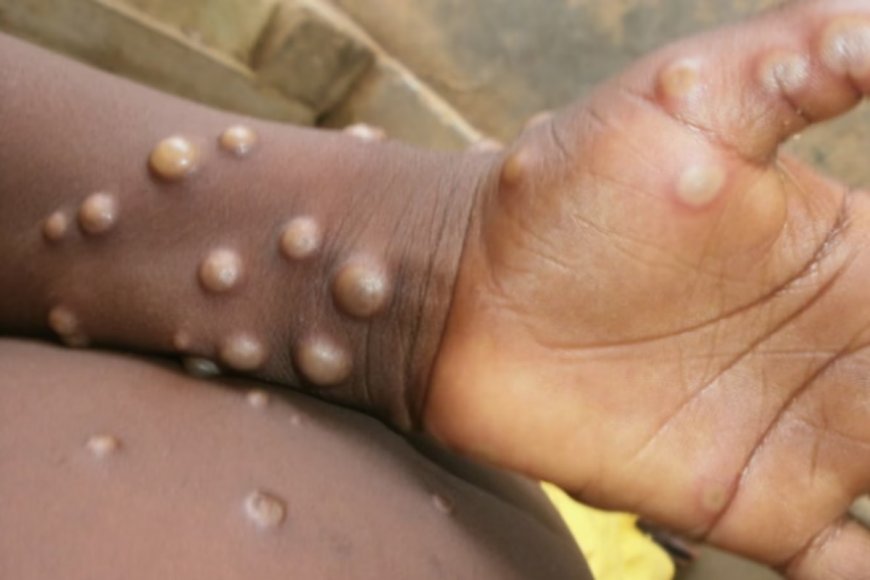 1st Suspected Case Of Monkeypox Reported In India, Health Ministry Issues Notification