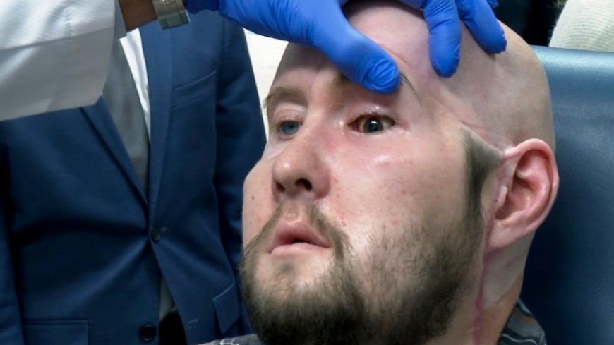 The first face transplant to include an eye shows no rejection a year later