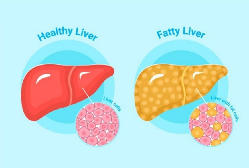 Can you reverse fatty liver? 5 things to know about this common disease